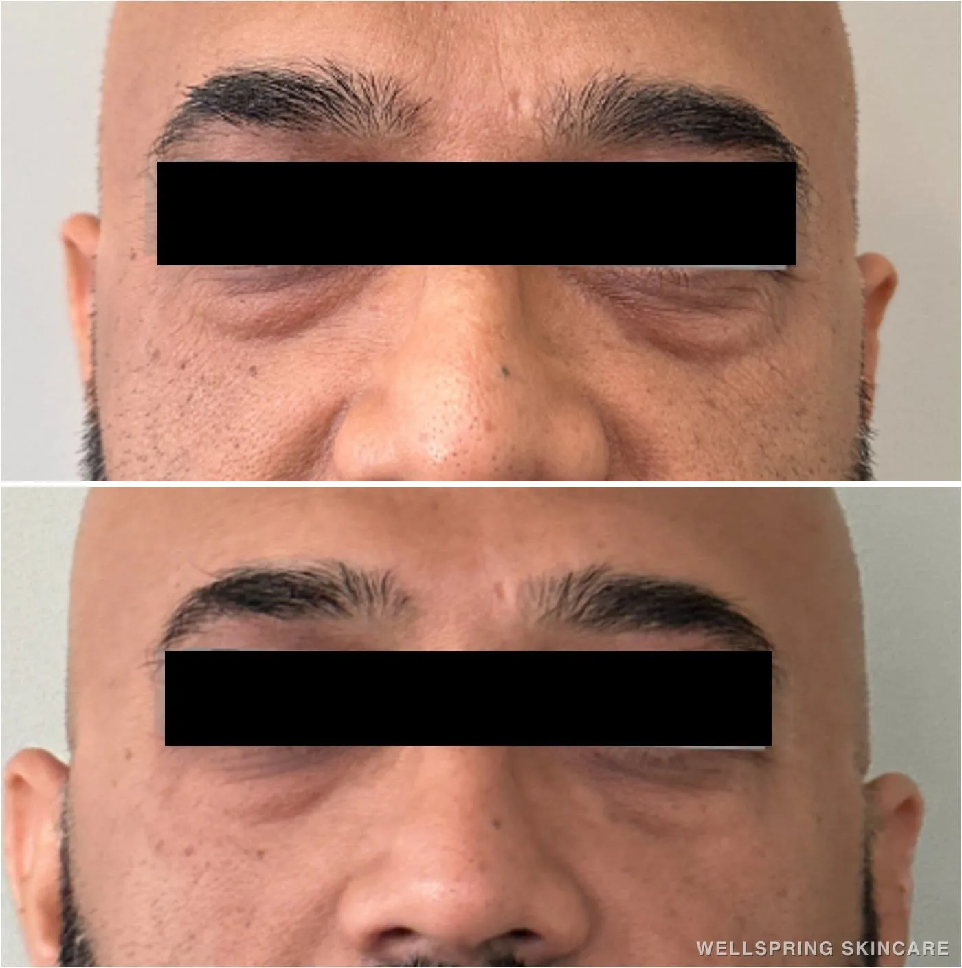 Before and after: Tired under-eyes treated with PRF