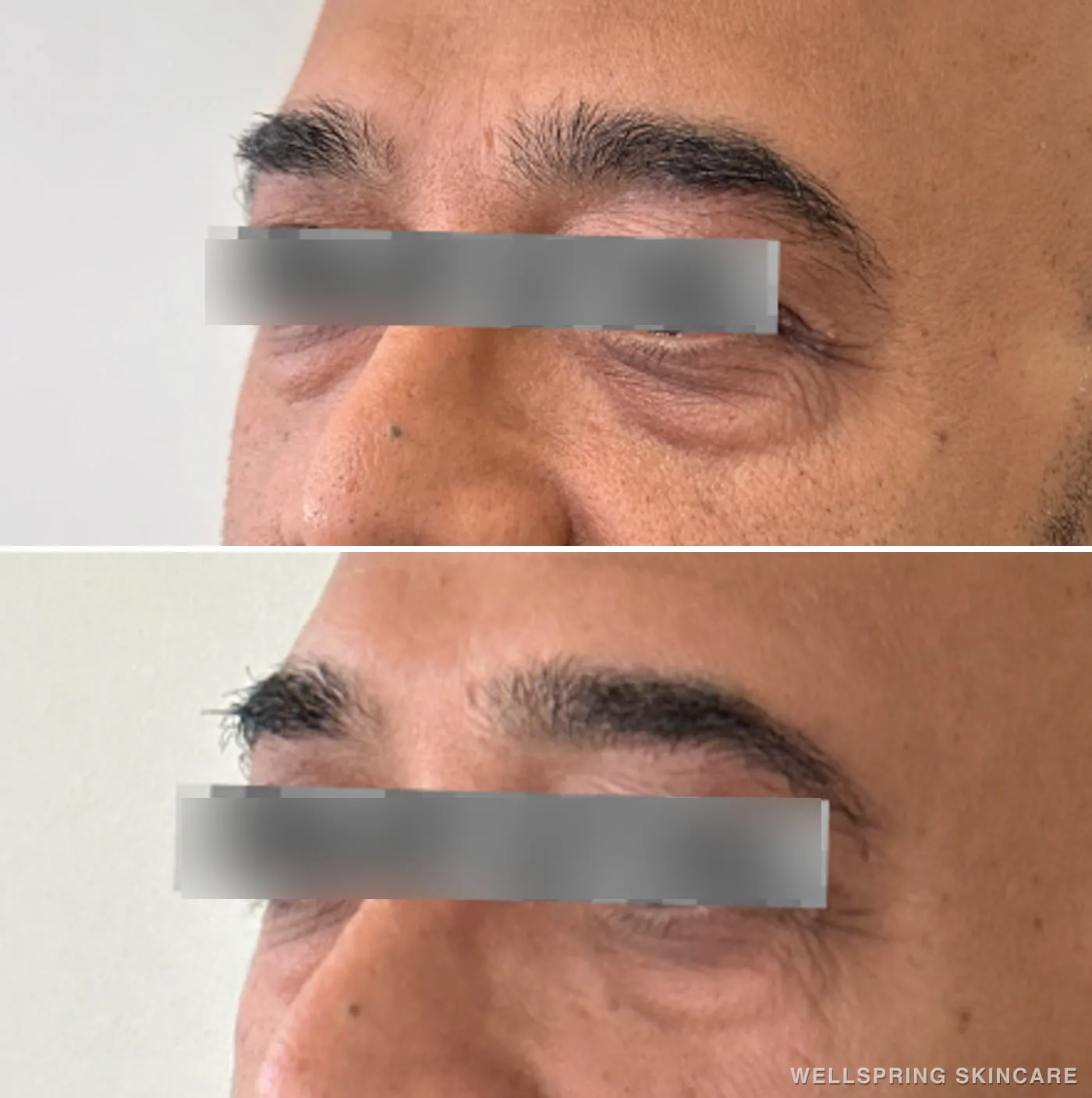 Before and after: Under-eye bags treated with PRF