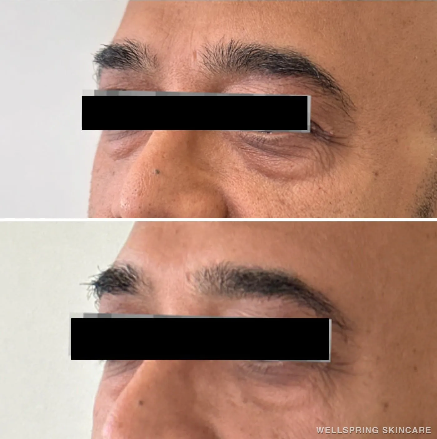 Before and after: Under-eye bags treated with PRF