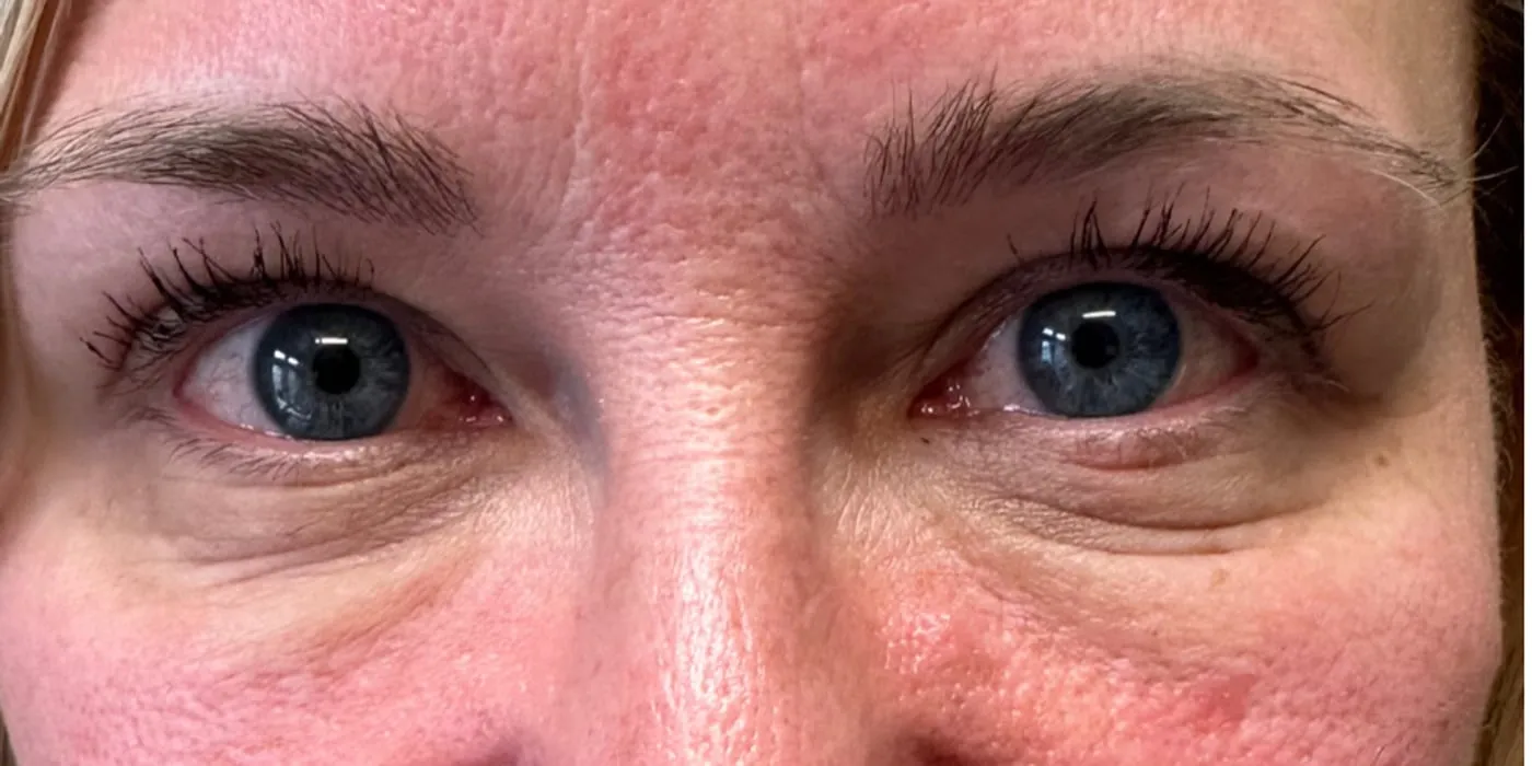 After: Dark eye bags treated with PRF