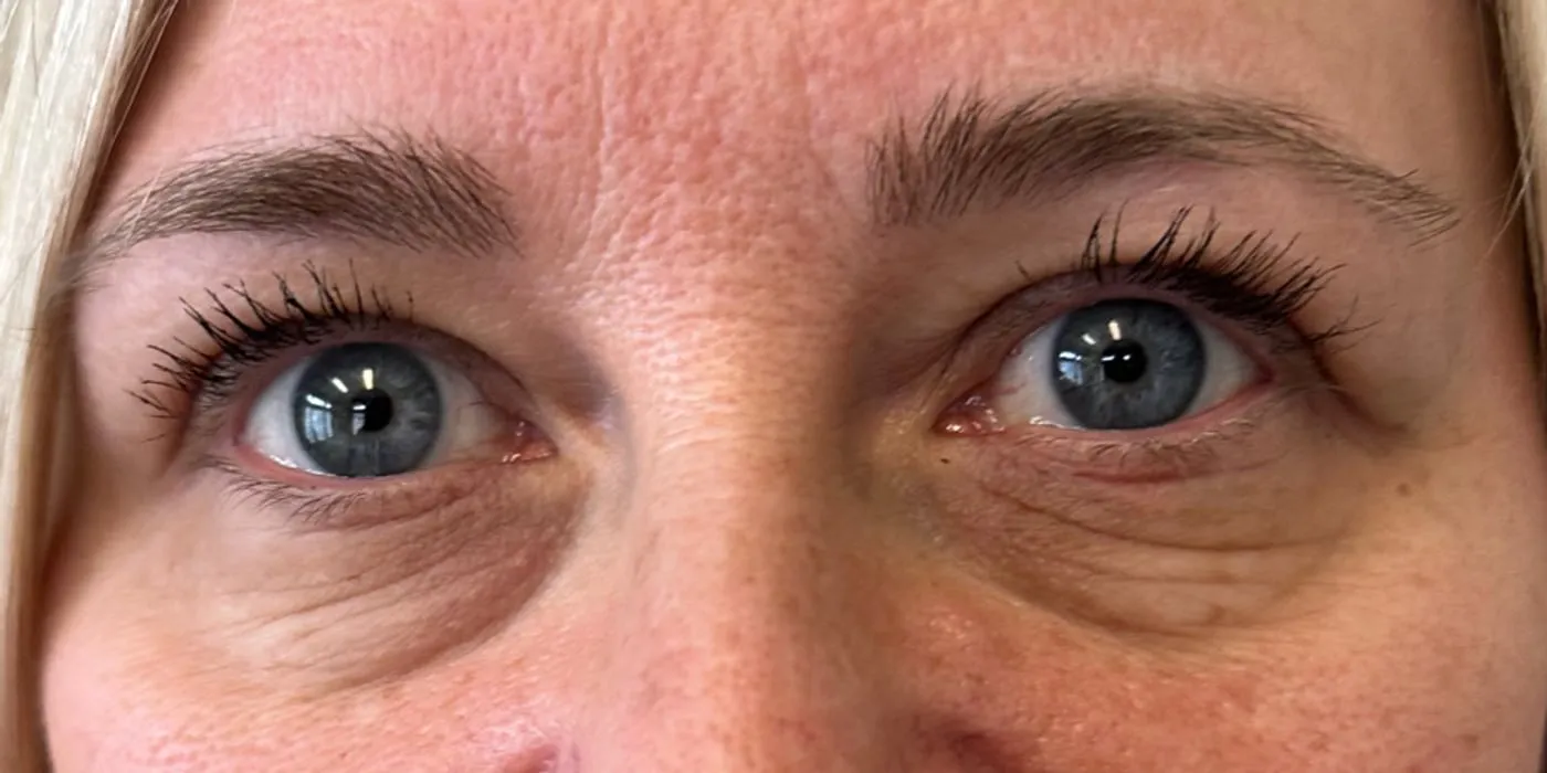 Before: Dark eye bags treated with PRF