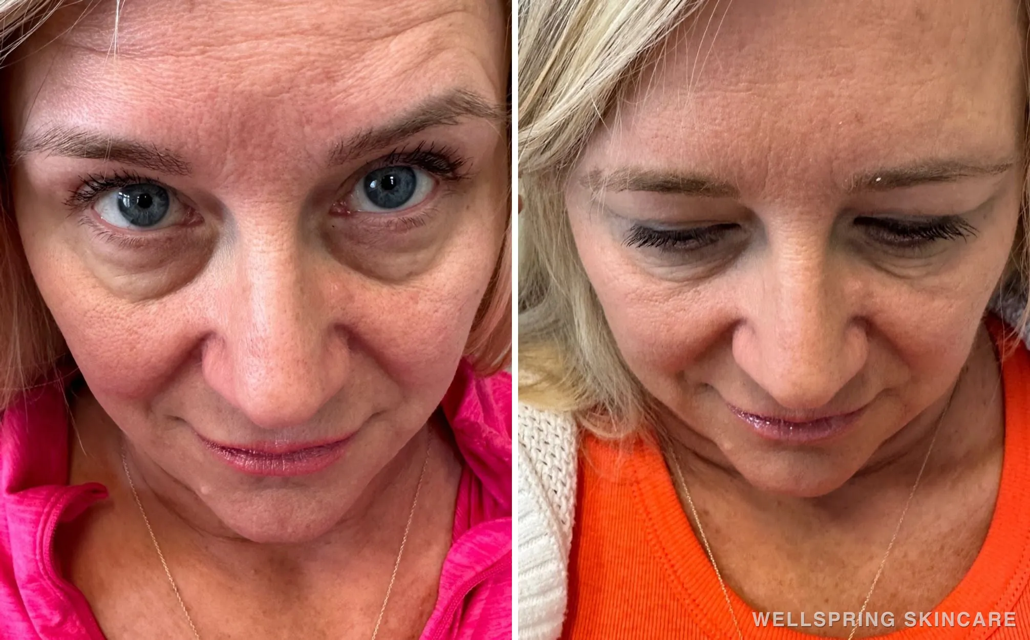 Before and after: Dark eye bags treated with under-eye PRF